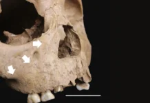Znamię zębowe i zmiany szkieletowe wrodzonej treponematozy we wczesnym rolnictwie Wietnamu (4000–3500 pb ) / Melandri Vlok, Tran Thi Minh, Nicola Czapliński, Hallie Buckley, Kate Domett, Hiep Hoang Trinh, Nguyen Thi Mai Huong, Nghia Thi Huu, Do Thi Kim Dung, Nguyen Thi Sau
